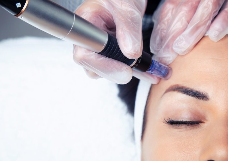 A microneedling pen being drawn across a client's forehead