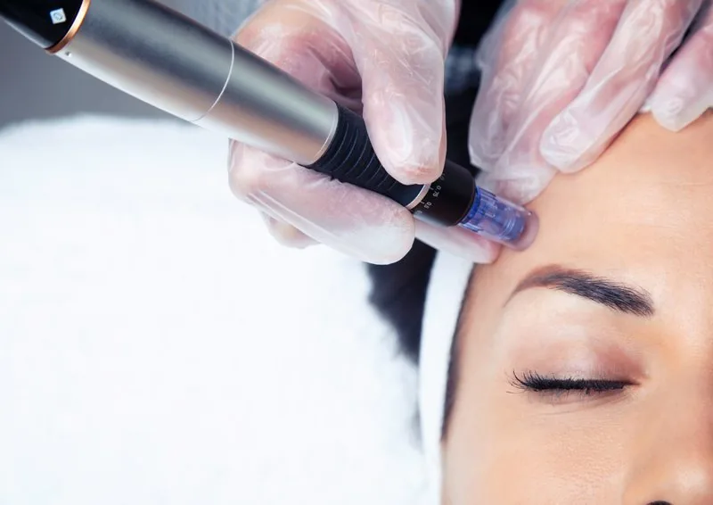 A microneedling pen being drawn across a client's forehead