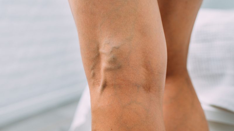 Vasculaze Vein Therapy